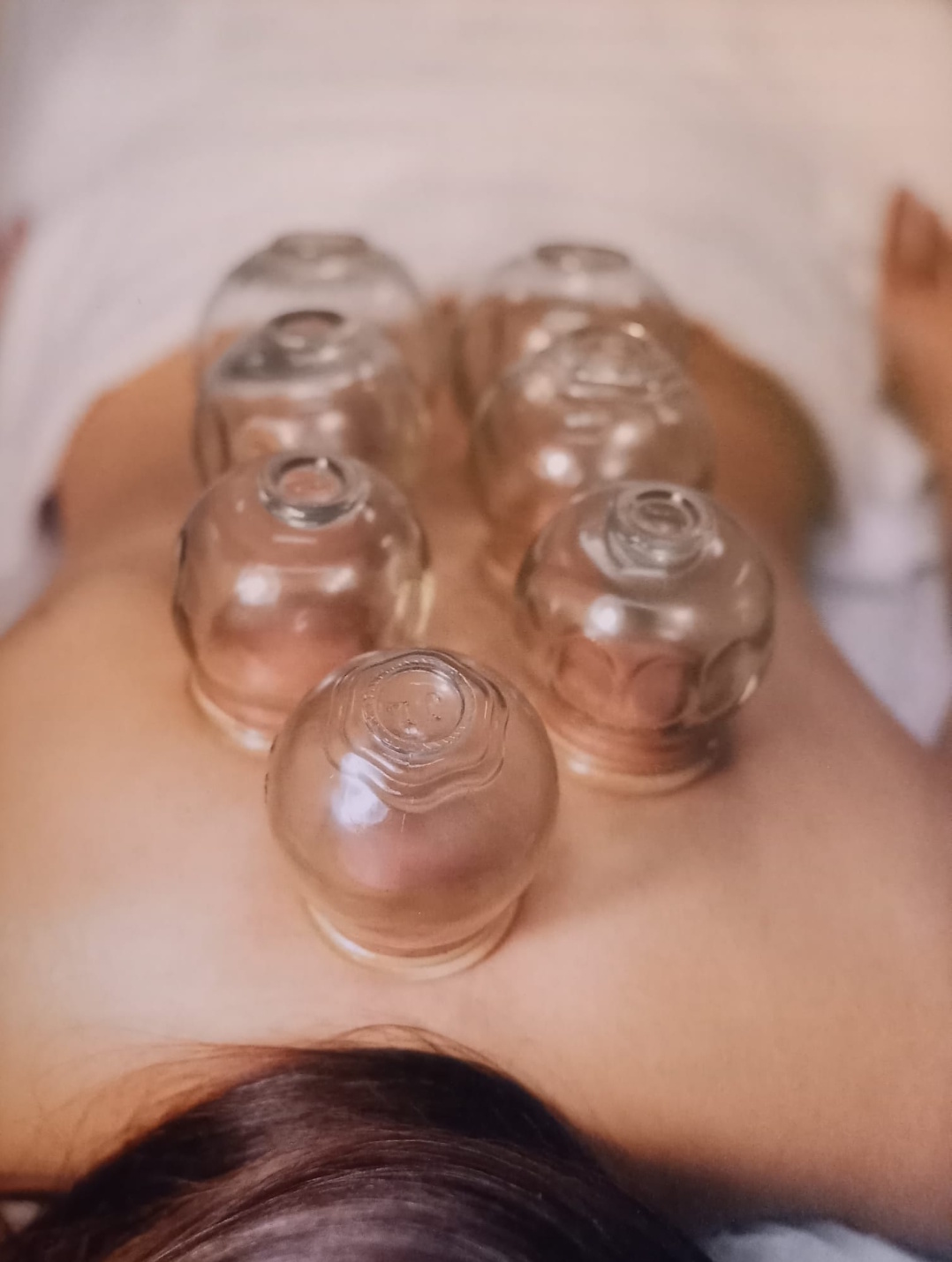 Vuurcupping behandeling